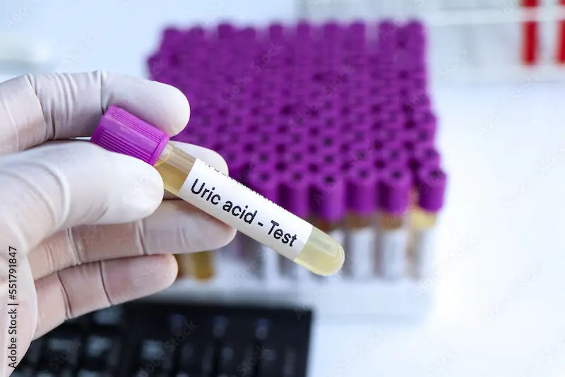 Uric Acid Levels and Management Options